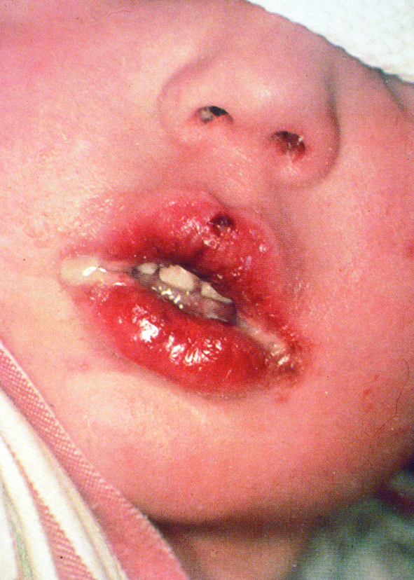 Oral herpes