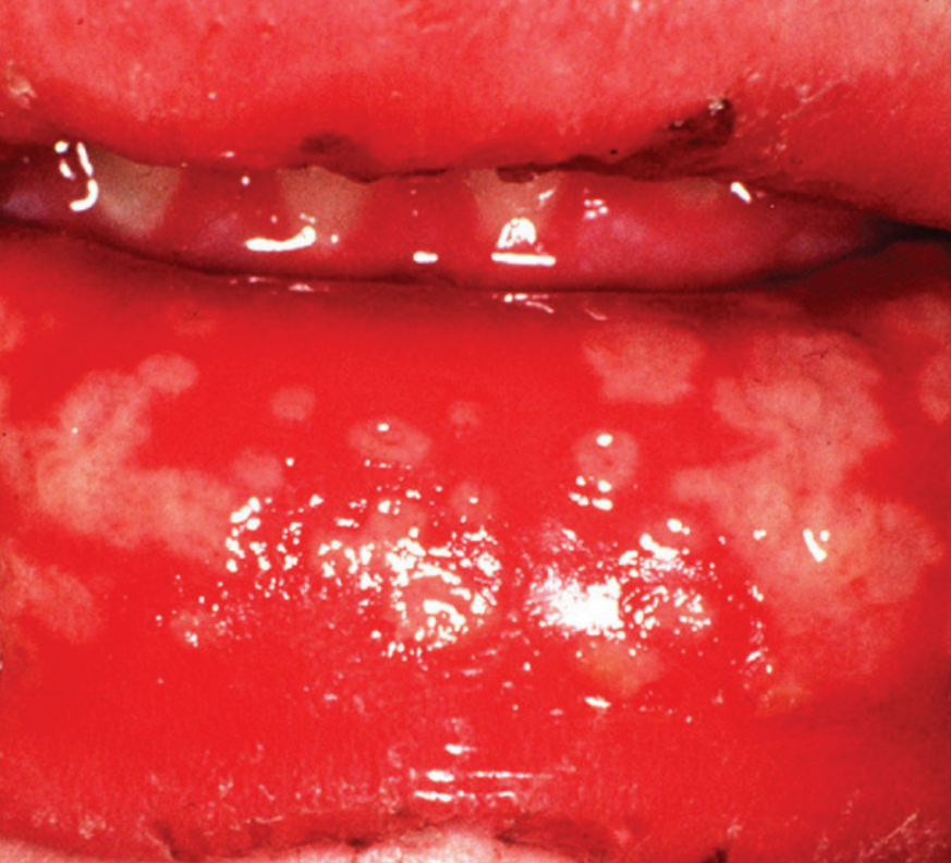 Oral herpes
