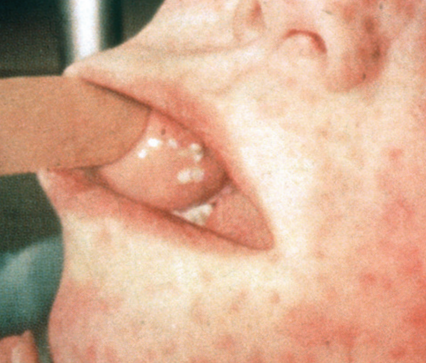 Skin rash and Koplik's spots