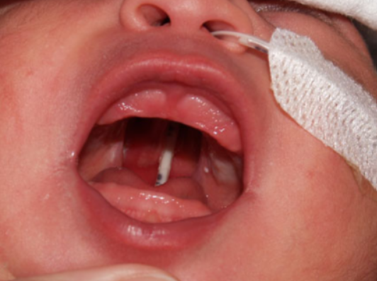 Cleft palate