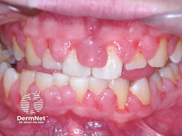 Image of gingival enlargement