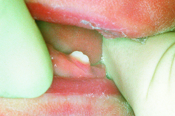 Natal tooth