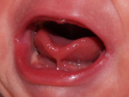 Tongue tie