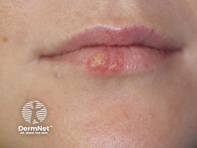 Herpes simplex