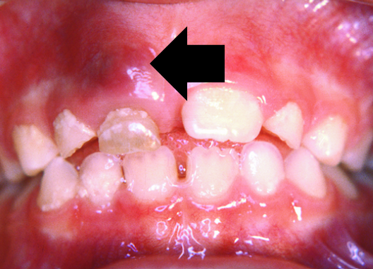 Dental abscess
