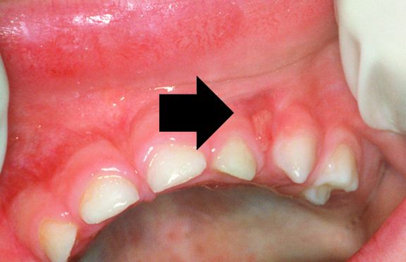 Dental abscess